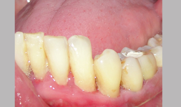 Preventative dentistry treatment in Anand
                        